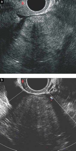 Sonographic Features Of Primary Ovarian Fibrosarcoma A Report Of Two Cases Testa 2009