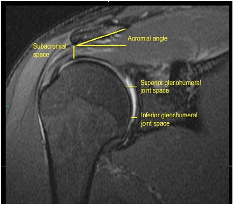 Table 1 From Axial Traction Magnetic Resonance Imaging Mri Of The