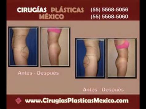 Cirugías Plásticas México Aumento de Glúteos Gluteoplastia YouTube