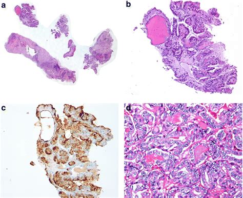 A B Core Needle Biopsies Of Papillary Thyroid Carcinoma Biopsy Samples