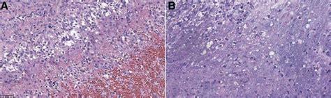 The Histopathological Findings Of The Surgical Specimen A