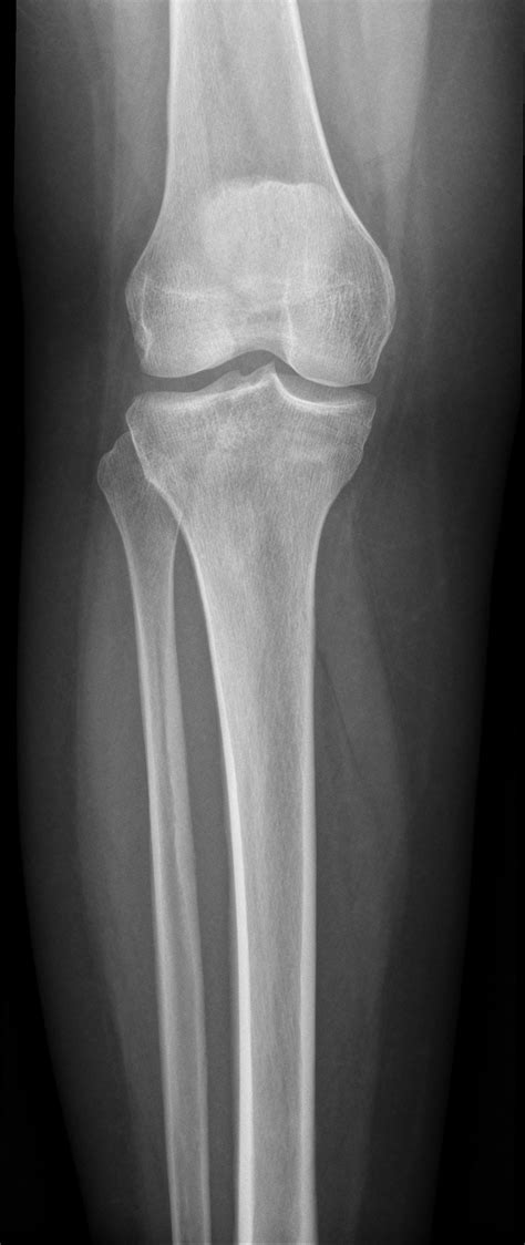 Unfused Tibial Tubercle Image