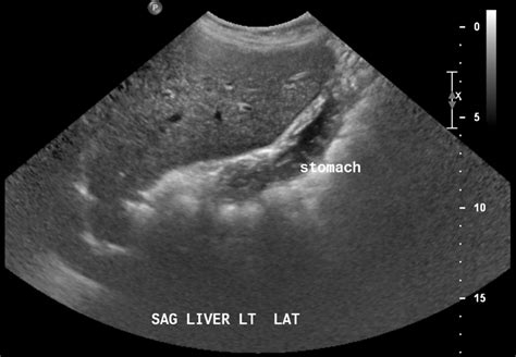 Cavernous Hemangioma Liver Ultrasound