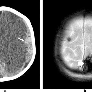 Month Old Boy Head Trauma Due To A Reported Fall From Height