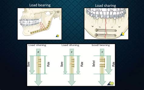 Rigid internal fixation | PPT