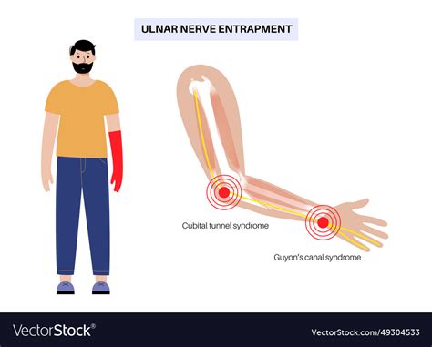 Ulnar nerve entrapment Royalty Free Vector Image