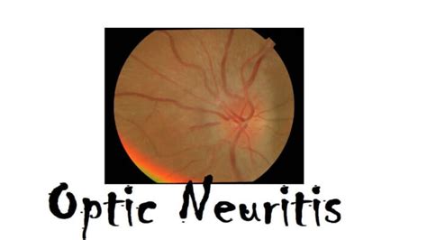 Optic Neuritis: 3 Risk Factors, Causes, Symptoms, And Diagnosis » 2023