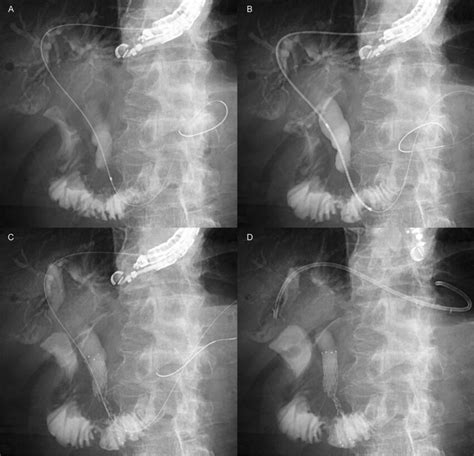 Endoscopic Ultrasound Guided Hepaticogastrostomy With Antegrade Download Scientific Diagram