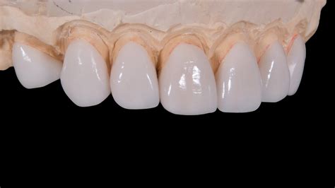 Different Types of Dental Crowns