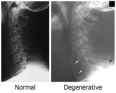 Cervical Disc Disorder