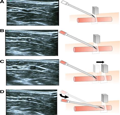 Dynamic Ultrasound Guided Short Axis Needle Tip Navigation T Anesthesia And Analgesia