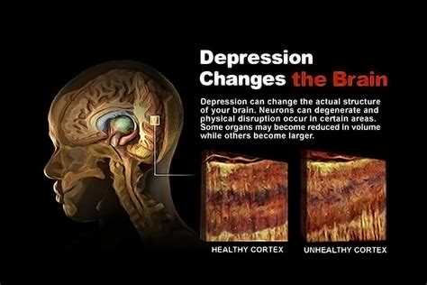 Depression Changes The Brain StoryMD