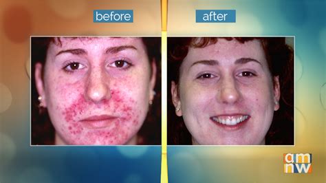 Aesthetic Medicine Help For Rosacea Katu