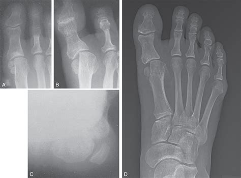 Hallux Varus and Complications of Bunion Repair - Clinical Tree