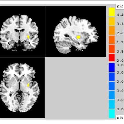 Clusters Showing Significantly Decreased Gray Matter Volume In AS