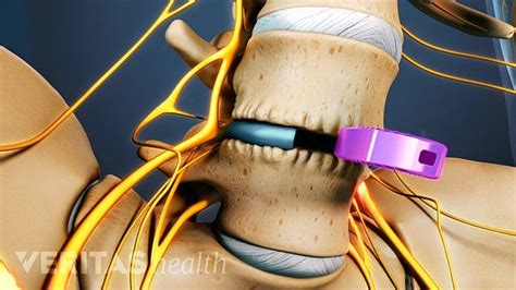 How An Anterior Lumbar Interbody Fusion Alif Can Stop The Pain