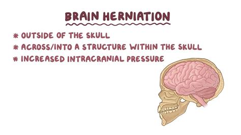 Brain herniation: Video, Anatomy, Definition & Function | Osmosis