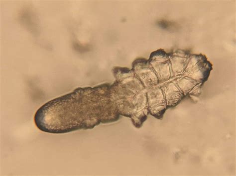 Demodex Infestation Diagnosis And Management Insight