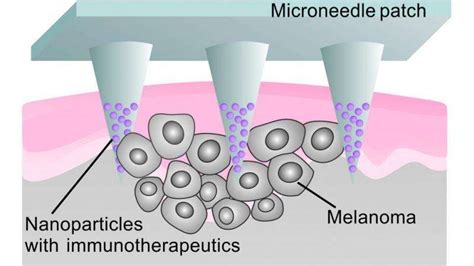 Microneedle Patch Delivers Localized Cancer Immunotherapy To Melanoma