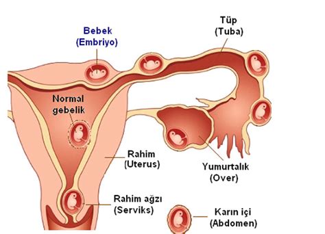 D Gebelik Nedir D Gebelik Nedenleri Belirtileri Ve Tedavisi