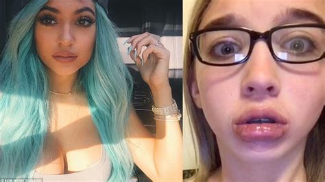 When The Kylie Jenner Lip Transformation Challenge Goes Wrong. Epic Fails!