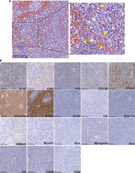 Frontiers Rhabdoid Meningioma With A History Of Budd Chiari Syndrome