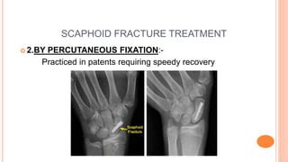 Scaphoid fracture | PPT