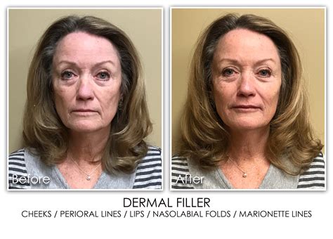 Lip Filler Archives Skin Rejuvenation Clinic Skin Rejuvenation Clinic