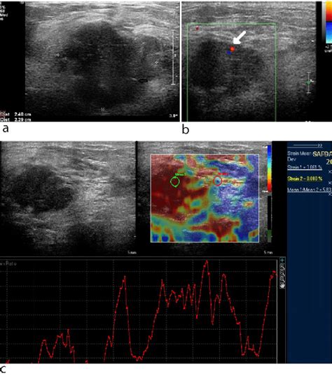 Ultrasound Of The Breast A Showing A Hypoechoic Lesion With An