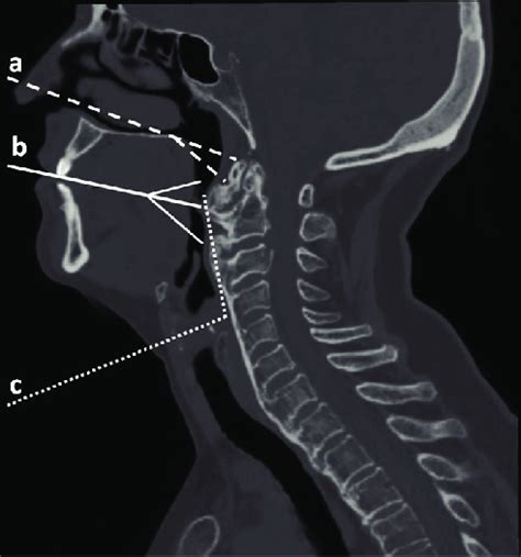 Schematic Approaches To The High Cervical C C Osteophytes A