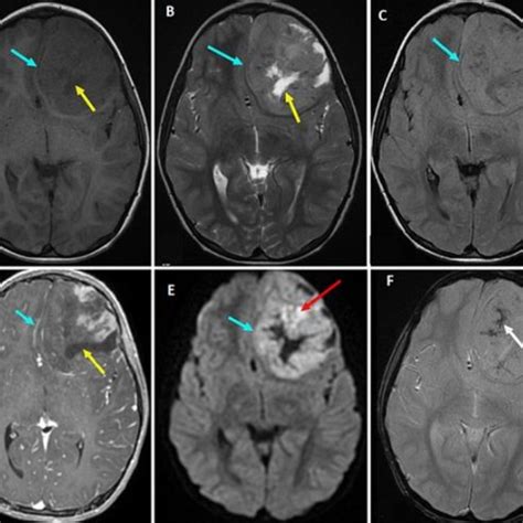 A) brain MRI in axial section showing a left basifrontal intra-axial... | Download Scientific ...