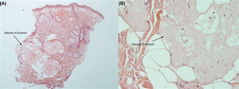 Curious Facial Plaque Diagnosed As Nodular Primary Localised Cutaneous Amyloidosis Bmj Case