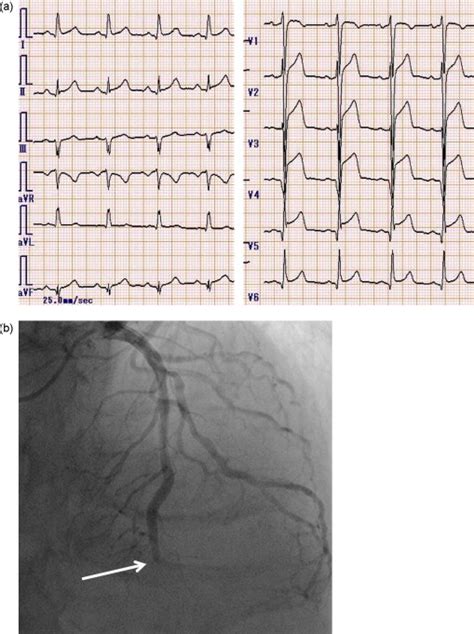 Infective Endocarditis Associated With Acute Myocardial Infarction Caused By Septic Emboli