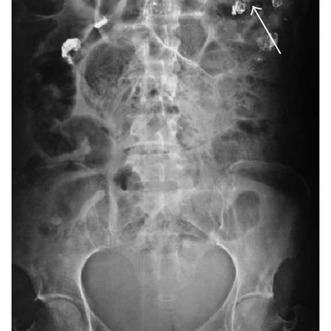 Computed Axial Tomography Of The Abdomen With Oral And Intravenous