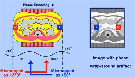 Wrap Around Artifact Questions And Answers In Mri