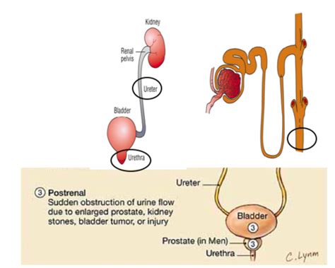 Internal Medicine EOR Nephrology Urology Flashcards Quizlet