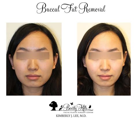 Buccal Fat Pad Removal Beverly Hills Cheek Fat Removal Los Angeles