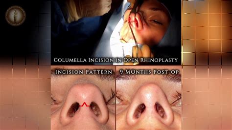 Columella Incision In Open Rhinoplasty Scar At 9 Months Post Op Youtube