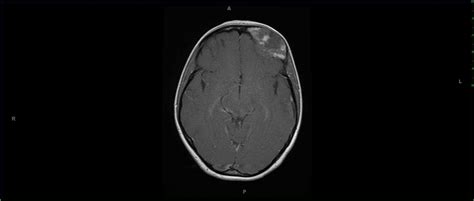 Fibrous Dysplasia MRI