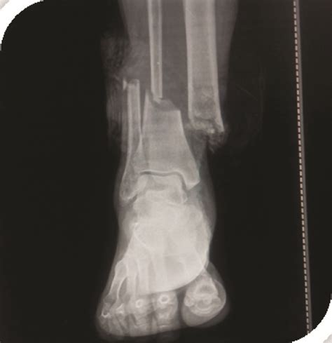 Compound Fracture X Ray