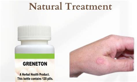 Healing Power Of Natural Treatment For Granuloma Annulare