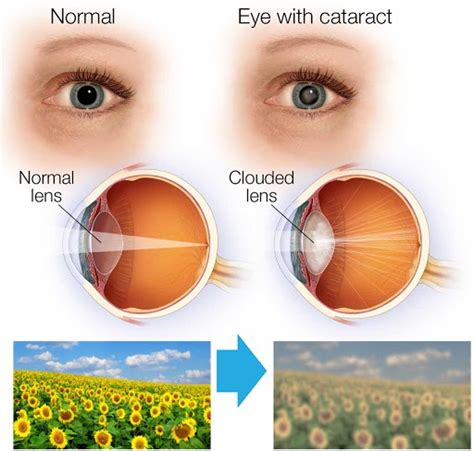 All You Need To Know About Cataracts Vision Express Saint Lucia