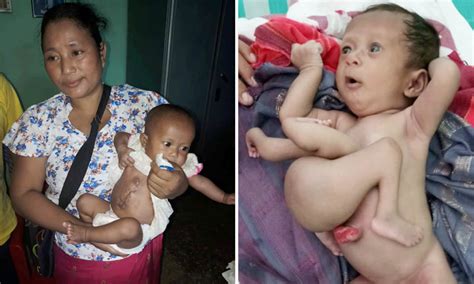 Infant Born With A Parasitic Twin Attached To His Stomach Archaeology 24