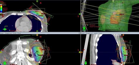 Accelerated Partial Breast Irradiation Apbi High Precision External