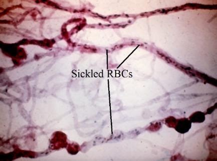 Moran Core Retina Rpe Histopathology