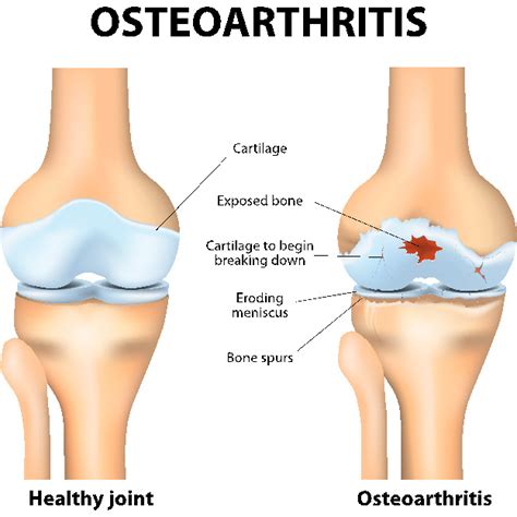 What Causes Lateral Knee Pain?