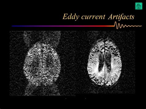 Artifacts In Mri