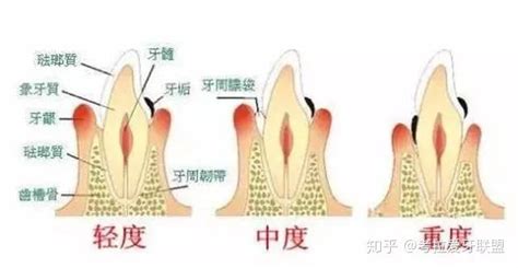 牙龈萎缩有多可怕？一定要治吗？ 知乎