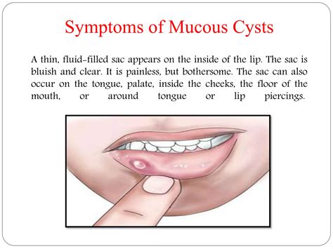 Mucous Cysts Mucoceles Symptoms Causes Treatment And Preventions Ppt