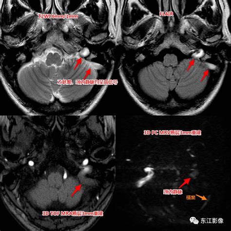 mri